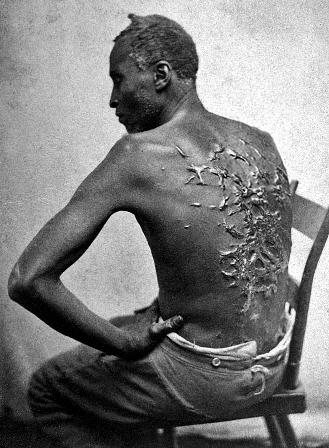 Otrok s následkami po bičovaní. Snímka vznikla v roku 1863 v americkej Louisiane.
