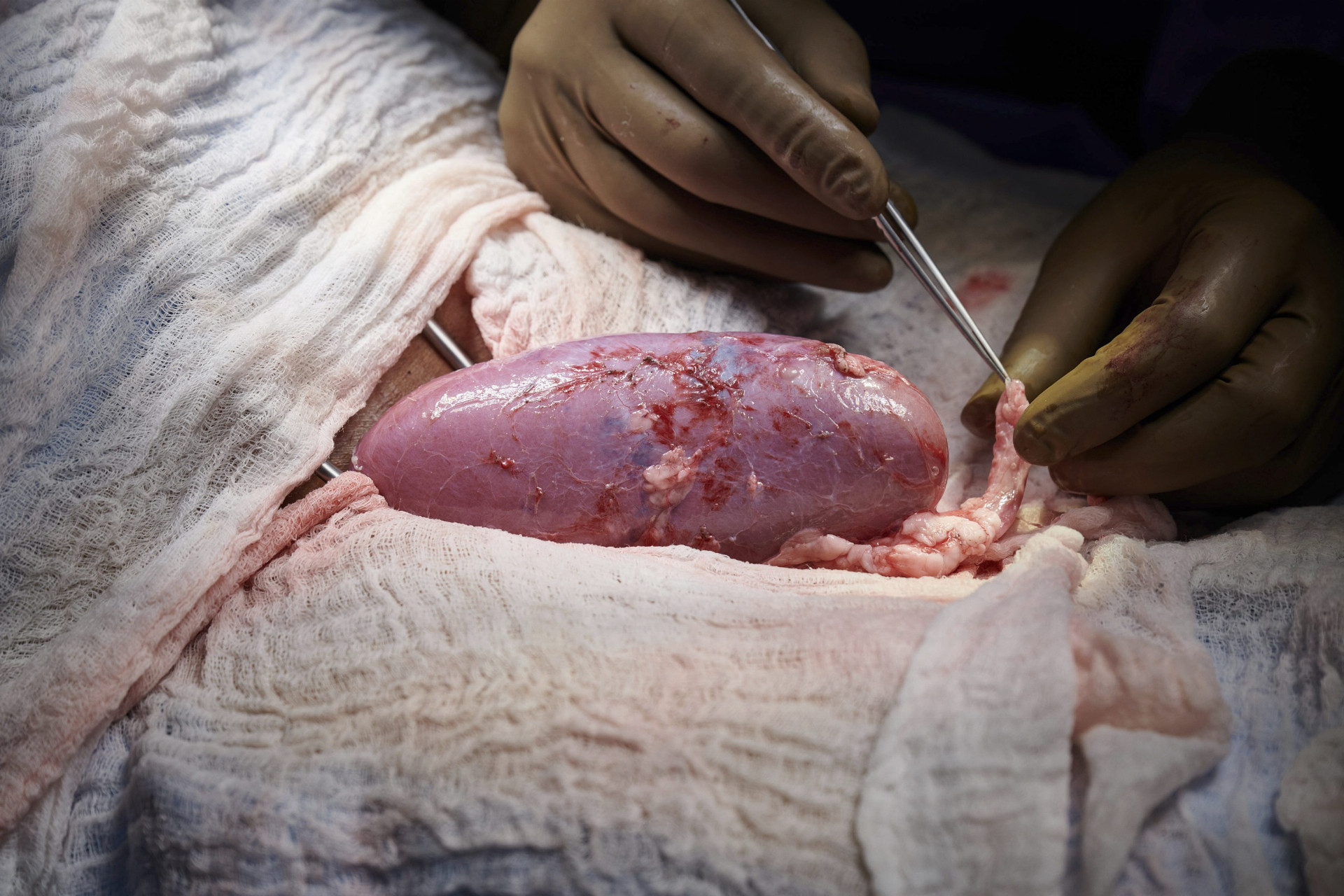 Chirurgický tím v nemocnici v New Yorku skúma prasaciu obličku pripojenú k telu zosnulého príjemcu