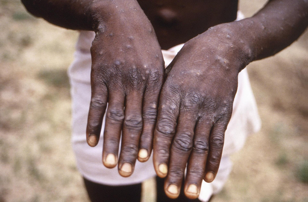 Na snímke z roku 1997 v Konžskej demokratickej republike sú ruky pacienta s opičími kiahňami.
