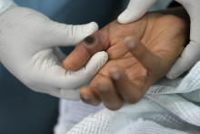 Lekár ukazuje vyrážku na ruke pacienta, ktorý sa lieči na ochorenie opičích kiahní. FOTO: TASR/AP