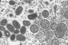 Zrelé vírusové častice opičích kiahní oválneho tvaru (vľavo) a sférické nezrelé vírusové častice získané zo vzorky ľudskej kože (vpravo).