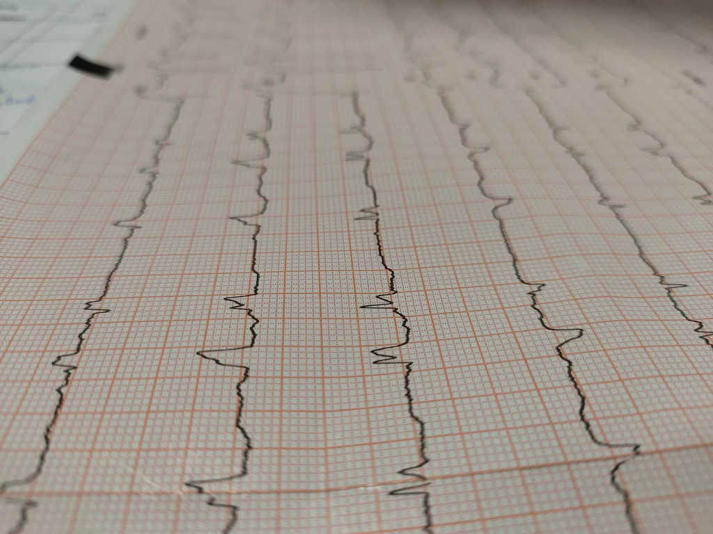 Tichý infarkt môže prebehnúť tak, že sa zistí až následne na EKG.