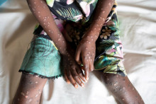Malý pacient nakazený mpoxom. FOTO: REUTERS