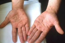 Sekundárna syfilisová vyrážka na dlaniach.