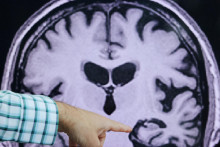 Mozog s Alzheimerovou chorobou.