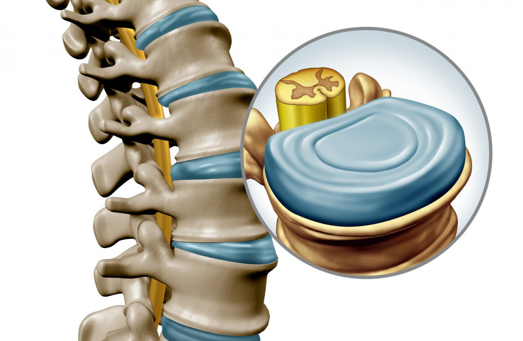 Bolesti chrbtice a problémy s medzistavcovými platničkami sú dnes najčastejším dôvodom invalidity produktívnych osôb.