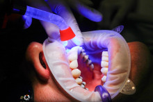 Pri strate zuba je najčastejším riešením zavedenie mostíka alebo implantátu s korunkou