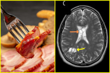 Muž zjedol nedopečenú slaninu. Lekári odhalili, že má v mozgu pásomnicu.