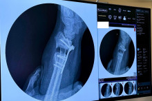Unikátna operácia: korekcia kostnej deformity pomocou 3D plánovania. Ide o novinku, ktorú vykonali lekári v Nemocnici AGEL Košice-Šaca