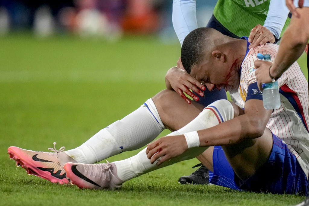 Zranený hráč Francúzska Kylian Mbappe, ktorý utrpel zlomeninu nosa. FOTO TASR/AP