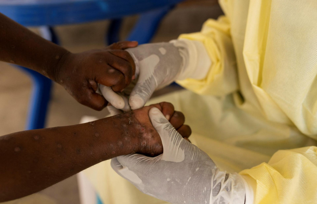 Laboratórna zdravotná sestra odoberie vzorku dieťaťu, u ktorého bolo vyhlásené podozrenie na Mpox. FOTO: Reuters