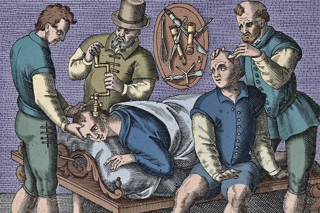 Trepanácie sa vykonávali už v neolite pomocou dlhých kostí s ostrým okrajom, alebo otvor do hlavy jednoducho vyškrabali. Táto ilustrácia pochádza z konca 16. storočia, keď na vyvŕtanie diery do hlavy poslúžil ručný vrták.