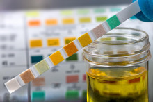 moč, vyšetrenie, kontrola, lakmusový papierik, laboratorium SNÍMKA: Shutterstock