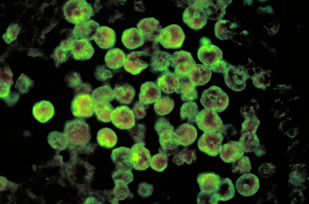 Histopatológia amebovej meningoencefalitídy spôsobenej Naegleria fowleri FOTO: Wikipedia/CDC/Dr. Govinda S. Visvesvara