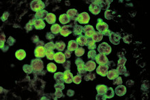 Histopatológia amebovej meningoencefalitídy spôsobenej Naegleria fowleri FOTO: Wikipedia/CDC/Dr. Govinda S. Visvesvara