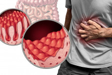 Z histamínovej intolerancie sa stal fenomén a výbušná téma. FOTO: Shutterstock