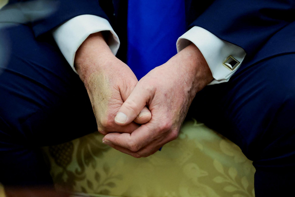 Trump je vo veku 79 rokov najstarším úradujúcim prezidentom USA a často sa chváli svojou vitalitou, najmä v porovnaní so svojím predchodcom Joeom Bidenom. FOTO: REUTERS