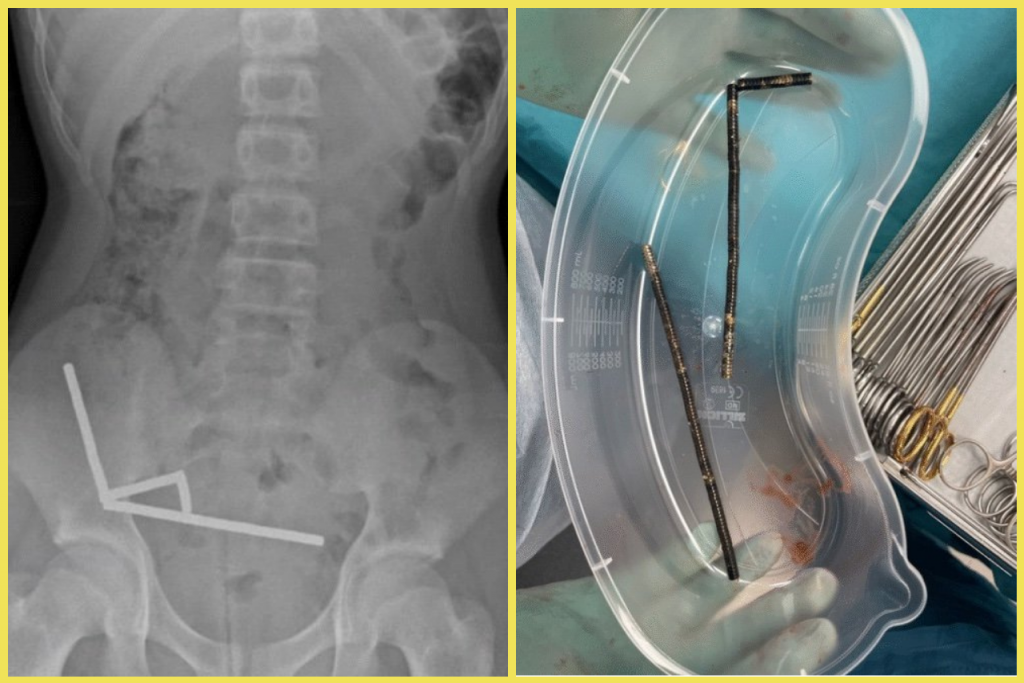 13-ročný chlapec prehltol takmer 200 magnetov