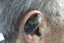 Ľuďom môžu narásť „rohy“