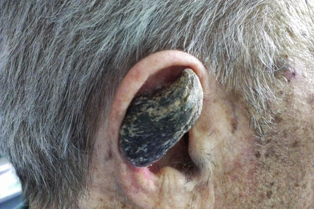 Ľuďom môžu narásť „rohy“