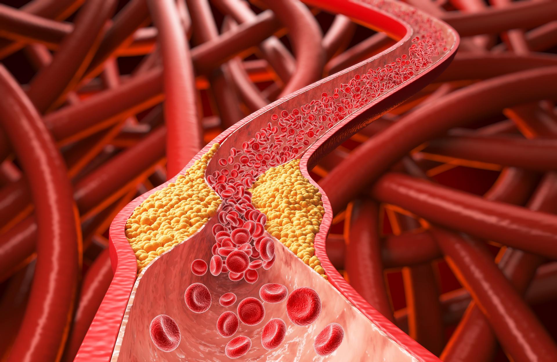 Neviditeľn&yacute; nepriateľ v krvi. Ktor&yacute;m m&yacute;tom o cholesterole odzvonilo?