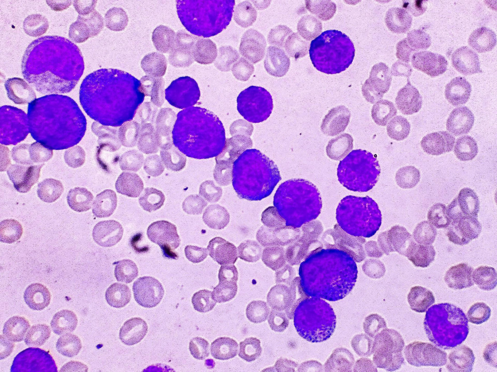 Mikrofotografia ak&uacute;tnej myeloblastovej leuk&eacute;mie. FOTO: Shutterstock